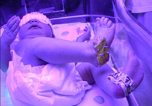 Hvordan bekjempe gulsott hos et nyfødt