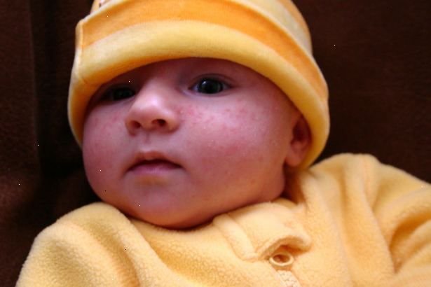 Hvordan å behandle babyen acne. Unn babyen acne helt forskjellig fra ungdom eller voksen akne.